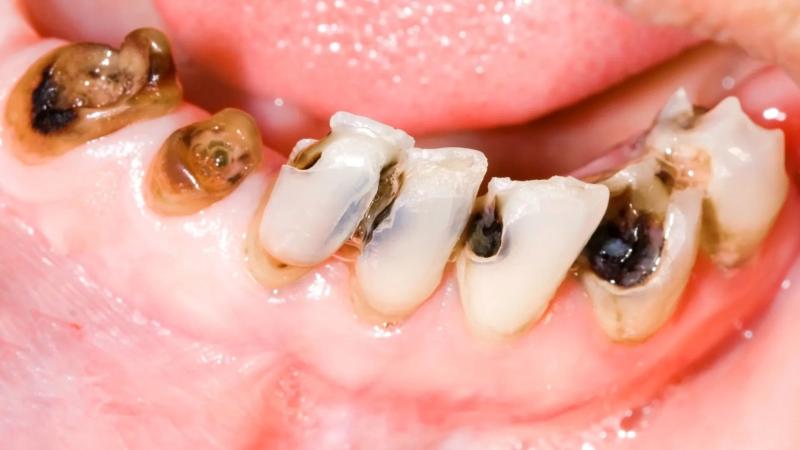 Thường nhổ răng sâu bao nhiêu tiền? Tất cả những thông tin bạn cần biết