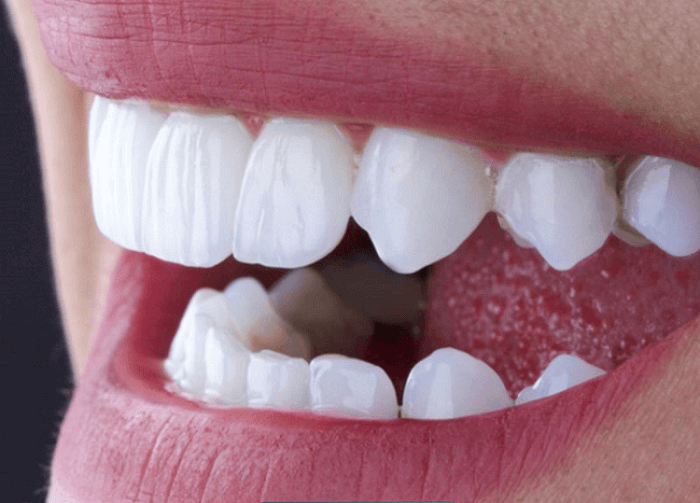 Làm răng sứ Zirconia giá bao nhiêu? Bảng giá làm răng tại Park Way