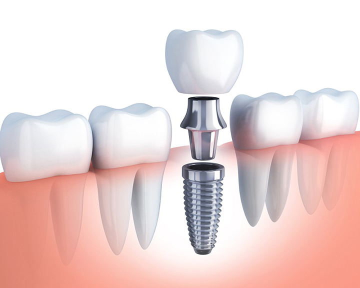 Làm răng implant là gì? Có nên là nha khoa thẩm mỹ hay không?