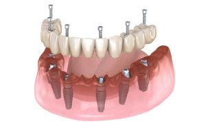 Trồng Răng Implant All On 6 là như thế nào?
