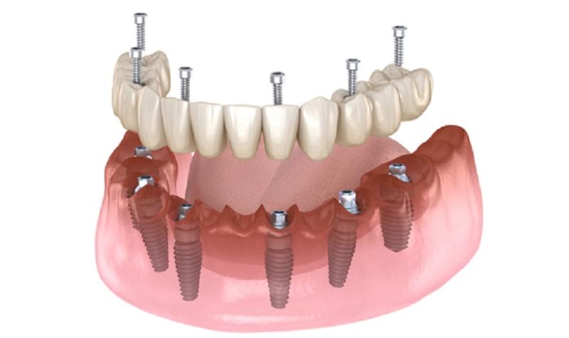 Trồng Răng Implant All On 6 là như thế nào?